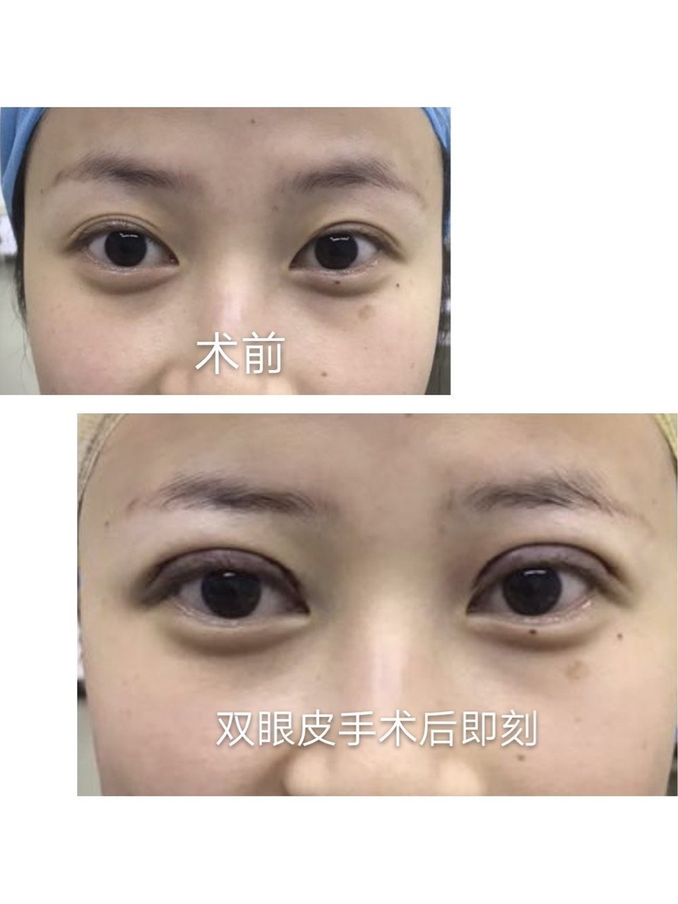 q:徐医生多层双眼皮做完全切手术后可以解决吗?
