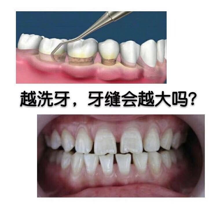 越洗牙,牙缝会变越大吗?