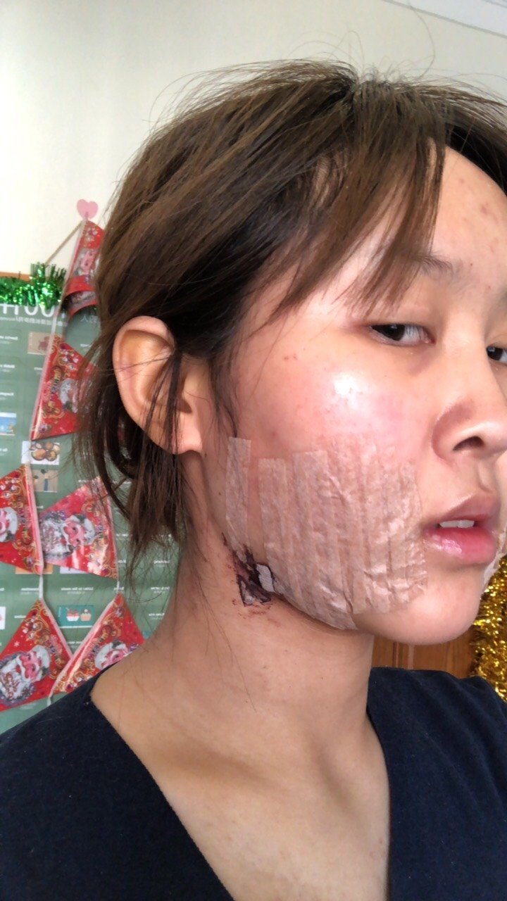 说一下我最近做的项目手工吸脂 光纤溶脂吸嘴角,因为自己六年级就有