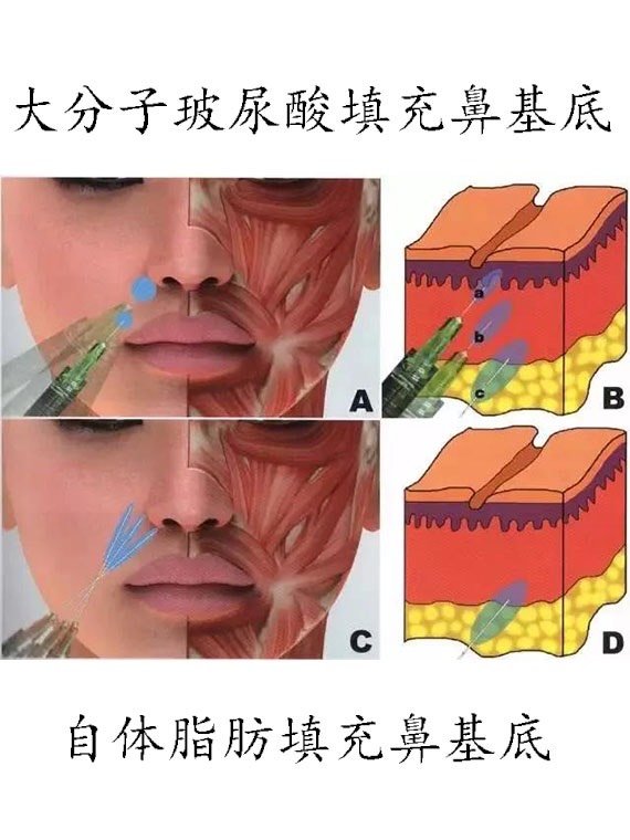 鼻基底塌,再好看的鼻子都白搭