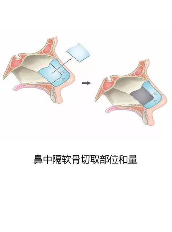 隆鼻软骨的吸收问题鼻中隔