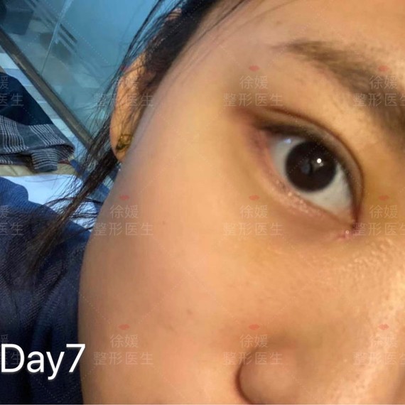 觉得术后即刻看起来眼角开的有点大,很不自然,但其实内眼角是会回缩的