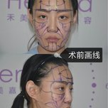 颧骨高不仅会显得太阳穴凹陷,还会显得人脸颊凹陷,会让人看