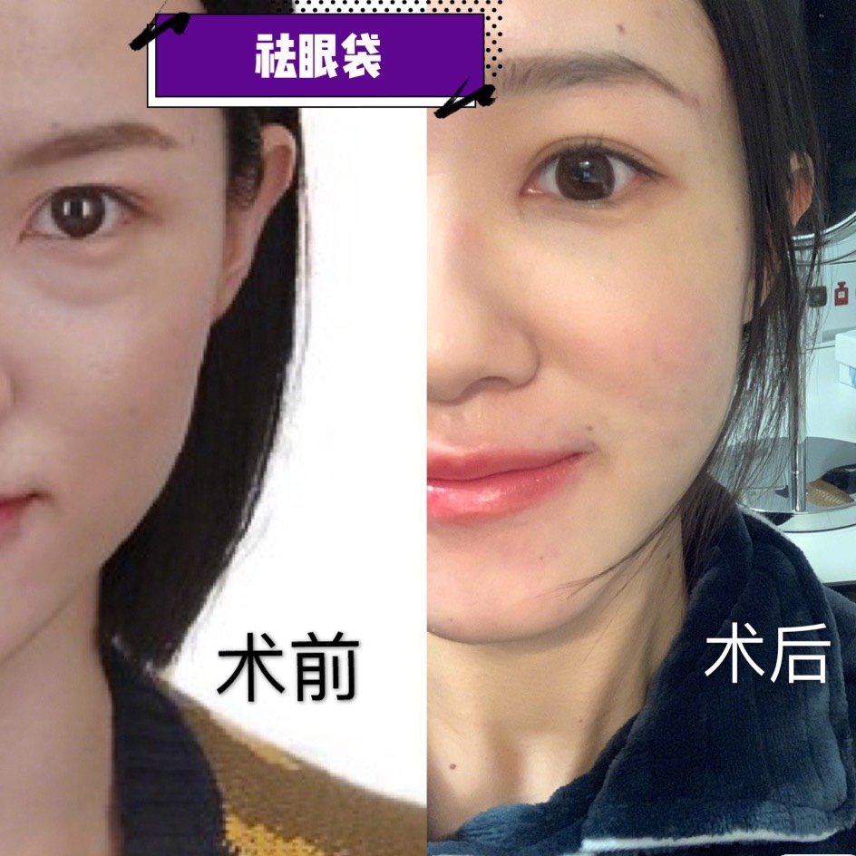 一般有脂肪型眼袋,松驰型眼袋,泪沟型眼袋,混合型眼袋,水肿型眼袋