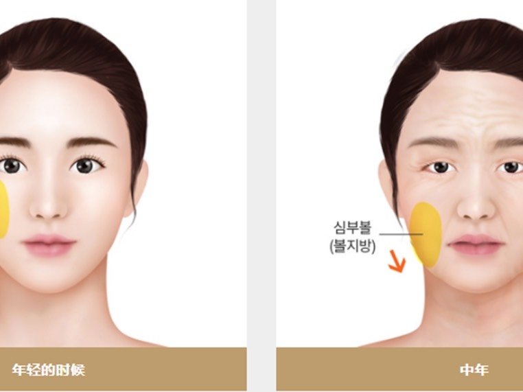 啥是木偶纹,讲具体一些,就是嘴角两边向下延伸的两条纹路,就像提线