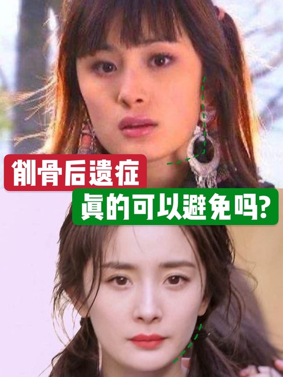 先来说说下颌角整形为什么会下垂吧 用杨幂举例,她确实是受削骨后遗症