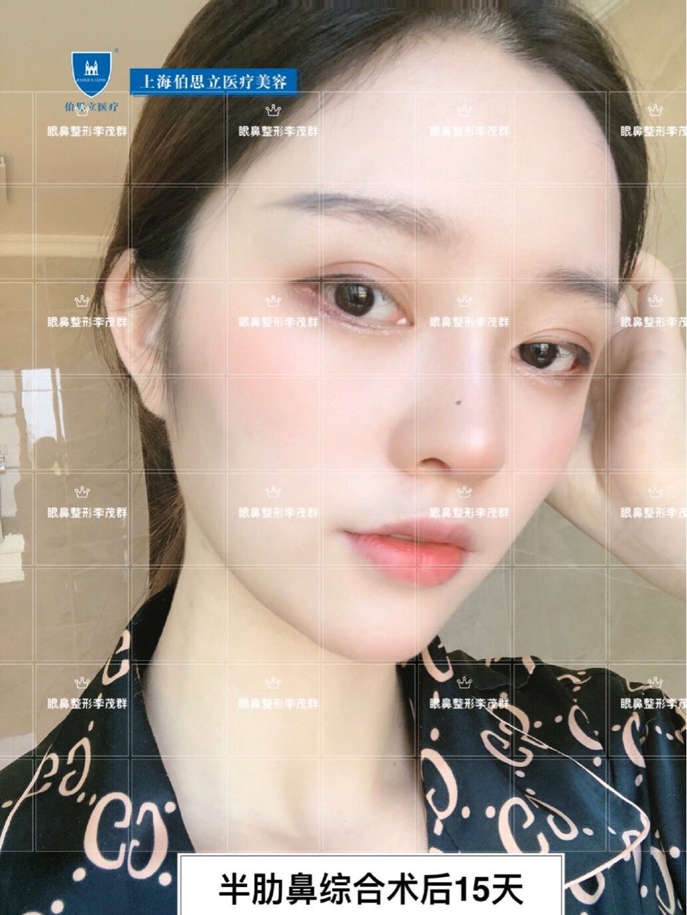 自然直鼻款#去年下半年开始来做这款鼻子逐渐多起来的一款鼻型.