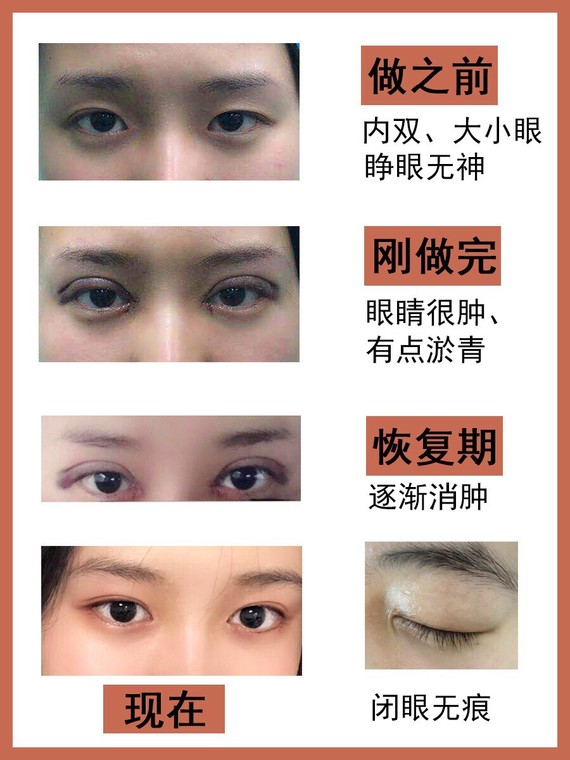 速看双眼皮攻略!总有一款适合你!