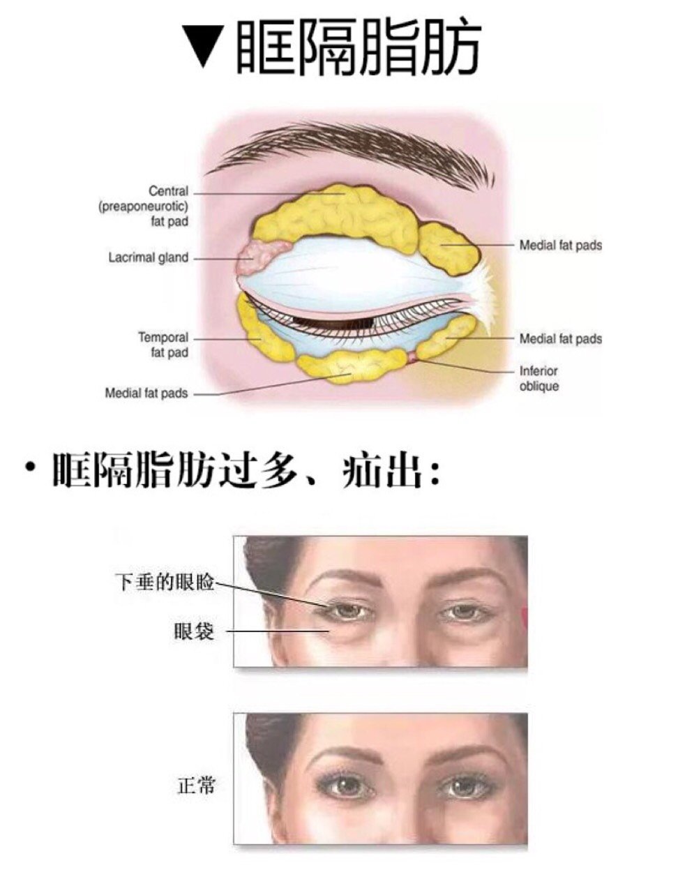 眼袋,泪沟问题及眼周脂肪较多可考虑眶隔释放手术.