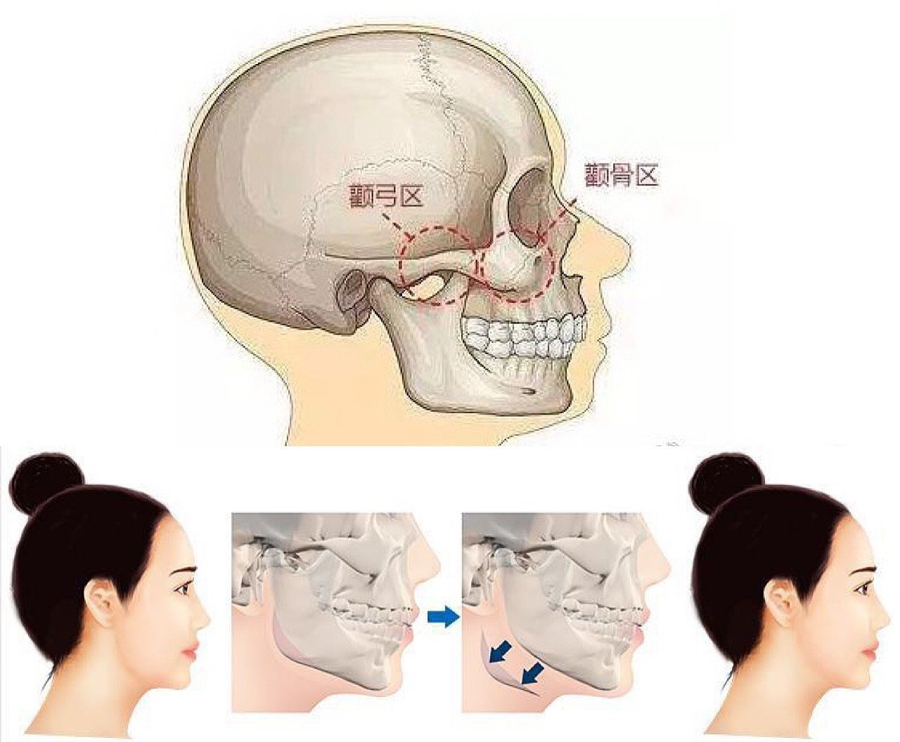 下颌骨不清晰?磨骨哪种方式更加呢?由骨骼原因引起的