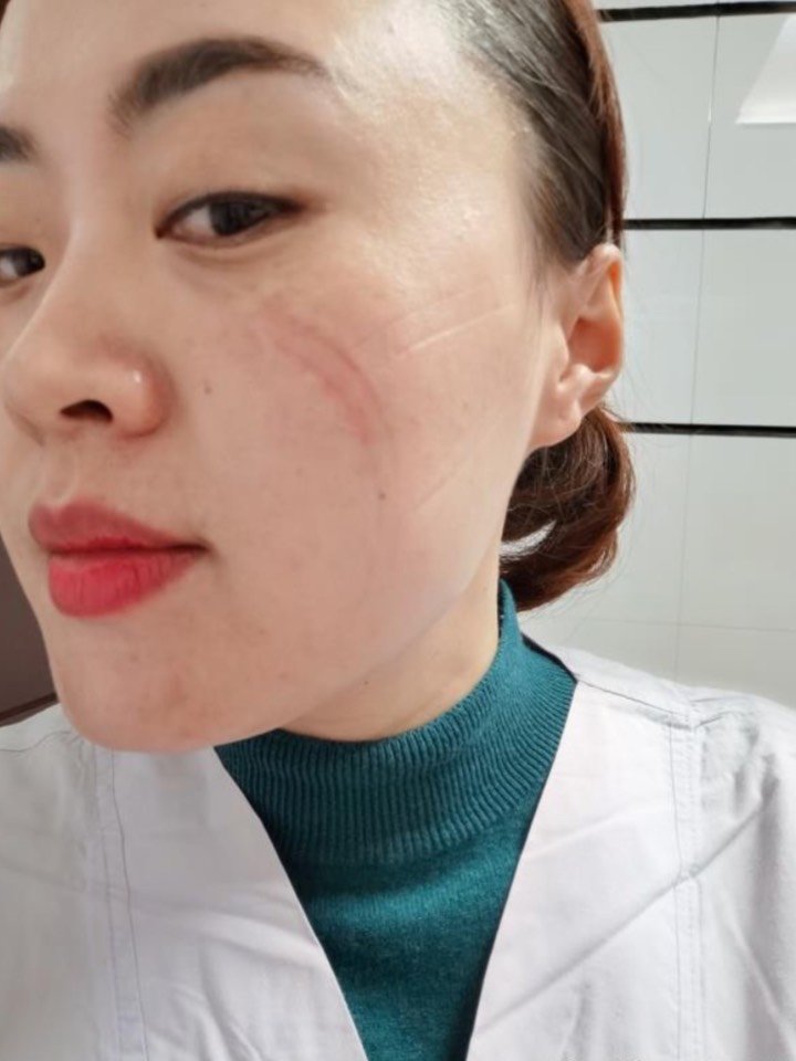 戴口罩引起压痕压疮怎么办