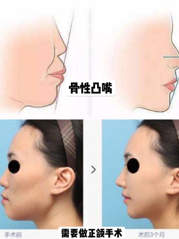 嘴轻重程度虽然有差别,但是给整张脸带来的影响是灾难性的,特别是侧脸