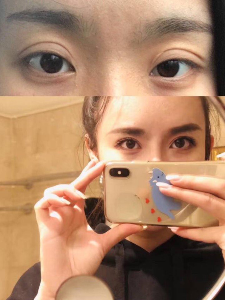 做完的双眼皮变成三眼皮了怎么办?
