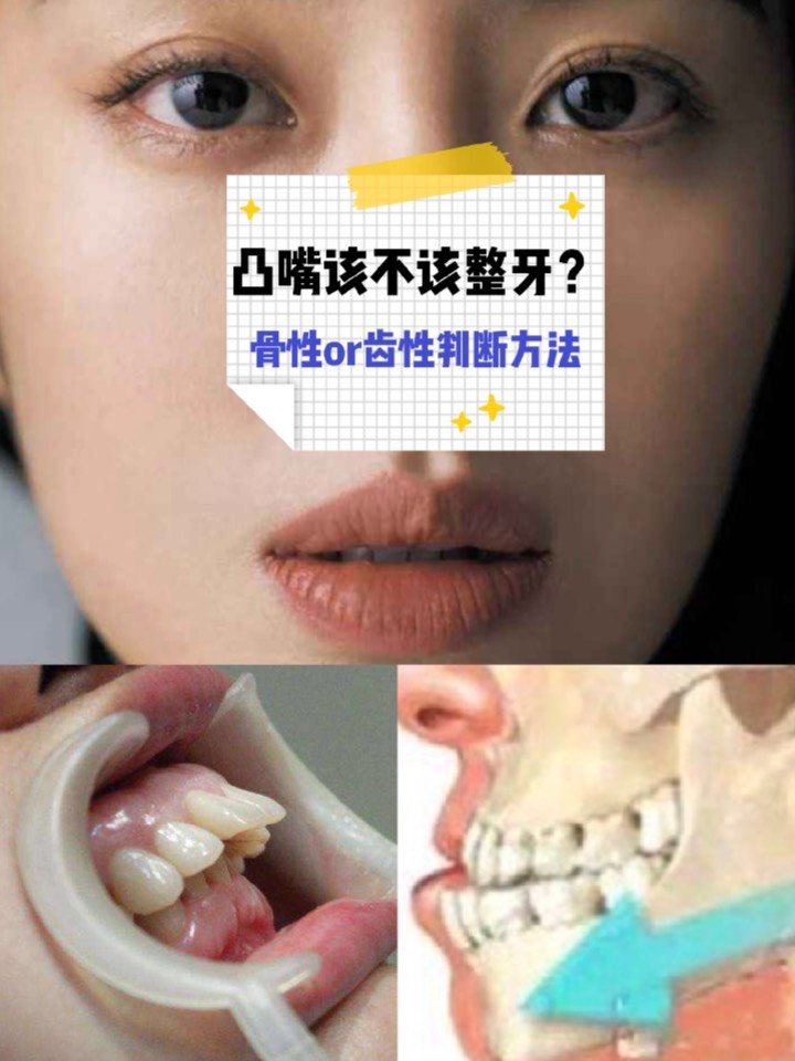 凸嘴该不该整牙?骨性or齿性判断方法