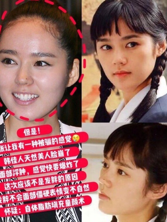 韩佳人整得面目全非,有图说真相01#隆鼻一时爽,太高_圈子-新氧美容