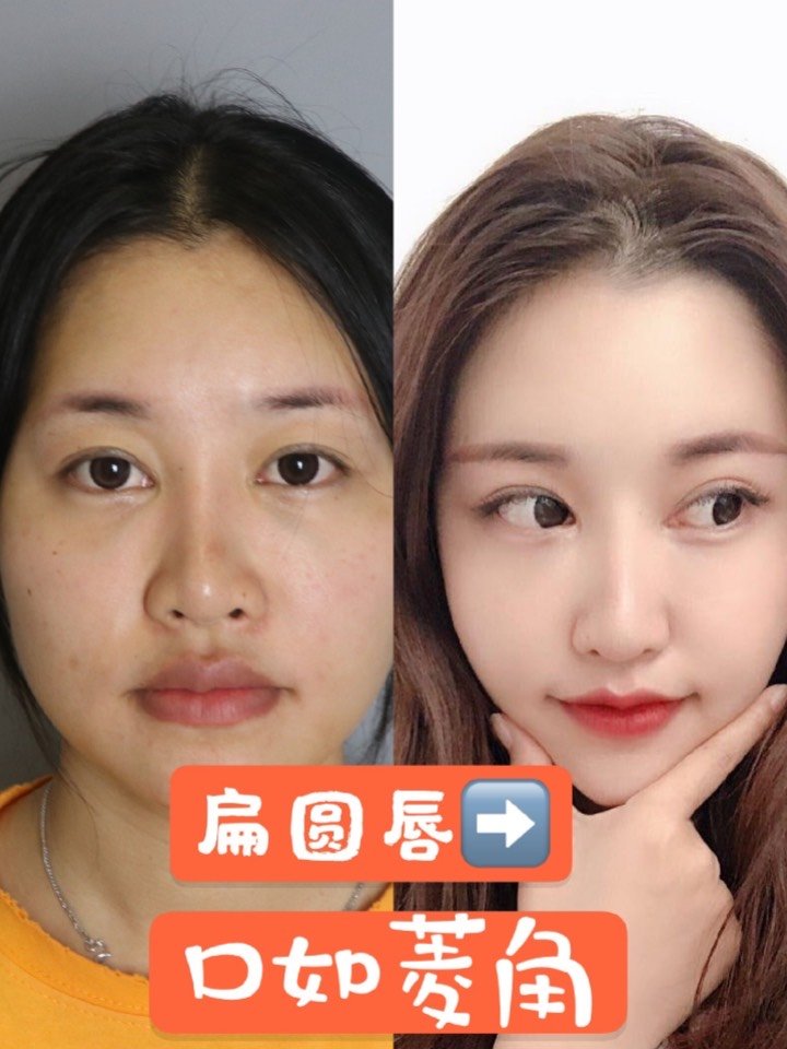 扁圆唇到口如菱角 微笑唇案例@致臻爱医疗美容