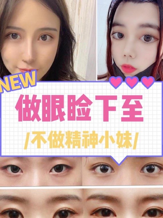 吊梢眼,外眼角上扬或者眼睑偏高,而眼睑下至能有效的改善,使得眼型