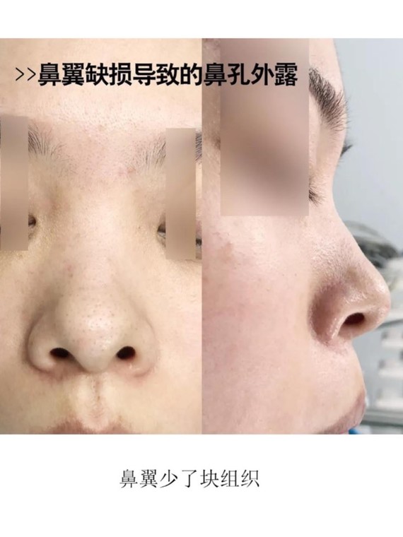 97教你判断鼻翼缘退缩or正常鼻孔暴露9595很多