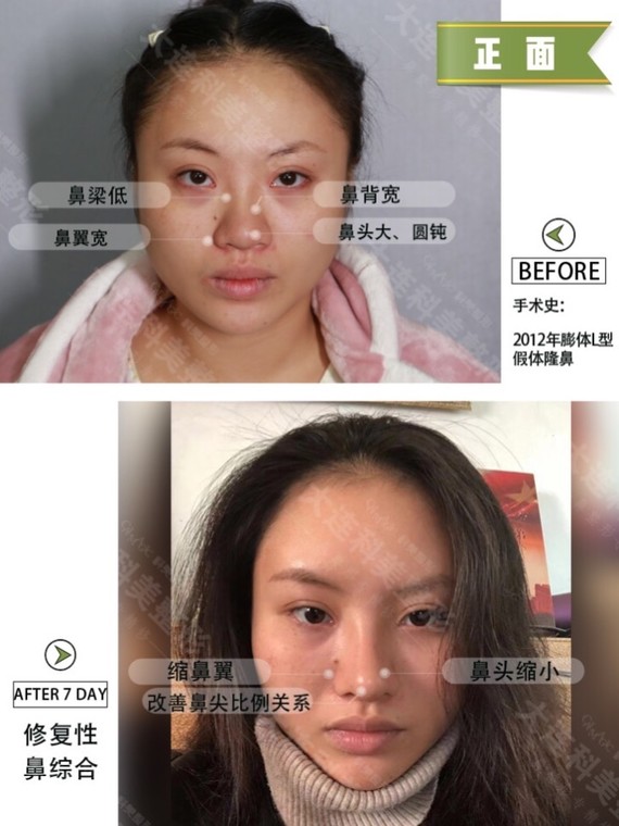 96塌鼻子可以说是好多妹子