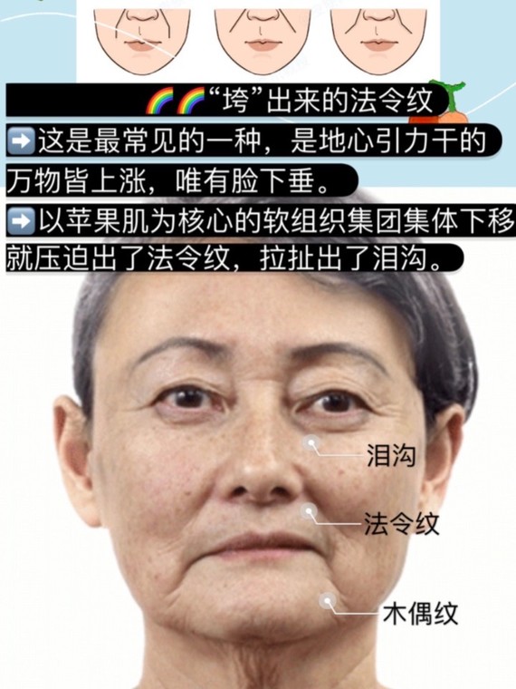 抗衰女孩自救需知:你的法令纹是以下哪一种?9494