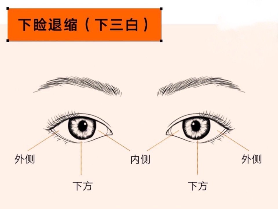 下三白(眼睛内,外,下都露白,医学上称为下睑退缩_圈子-新氧美容整形