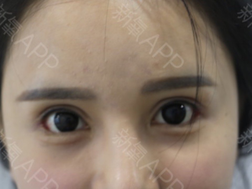 【外眼角下至第7天】#下眼睑下至