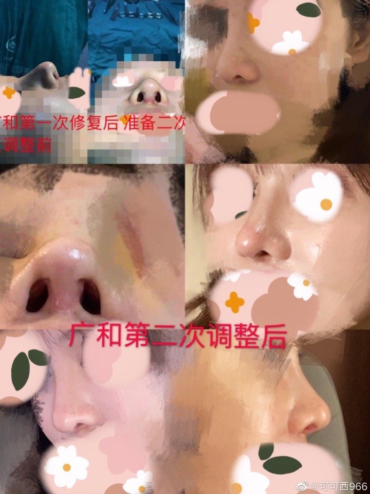 深圳广和尹卫民手术反馈你敢信这是一个东方鼻王做的鼻_圈子-新氧美容