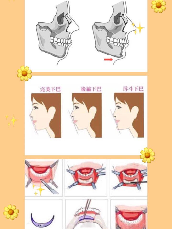 垫下巴那些事 垫下巴手术是指根据受术者的面部特点和下颌后缩
