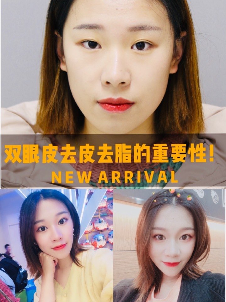 双眼皮去皮去脂是什么