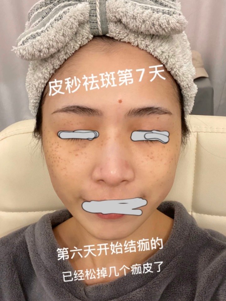 最美口罩脸 01今天是做了皮秒激光第八天,看了评价_圈子-新氧美容