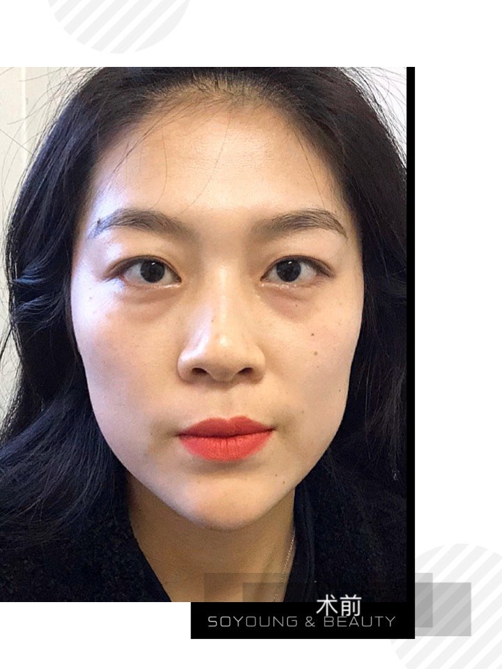 天生眼袋加上后期熬夜,30初头眼睛简直没眼看[哆_圈子-新氧美容整形