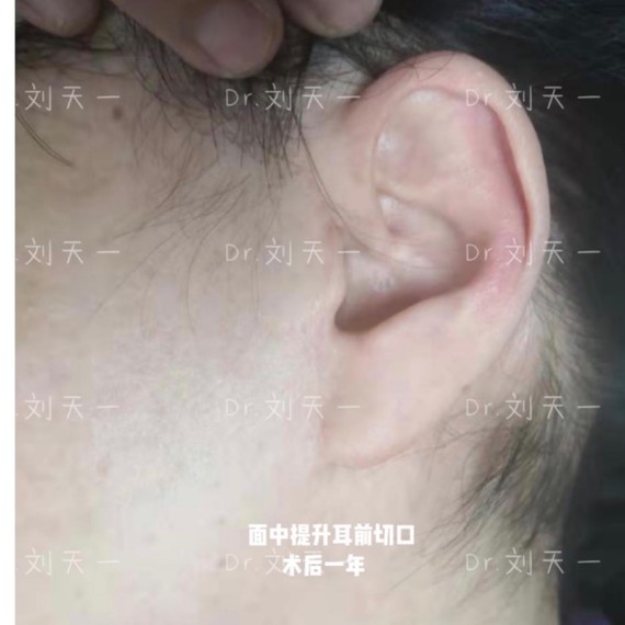拉皮是理解的,但是她对下眼睑部位还要再加一个手术切口表示不理解