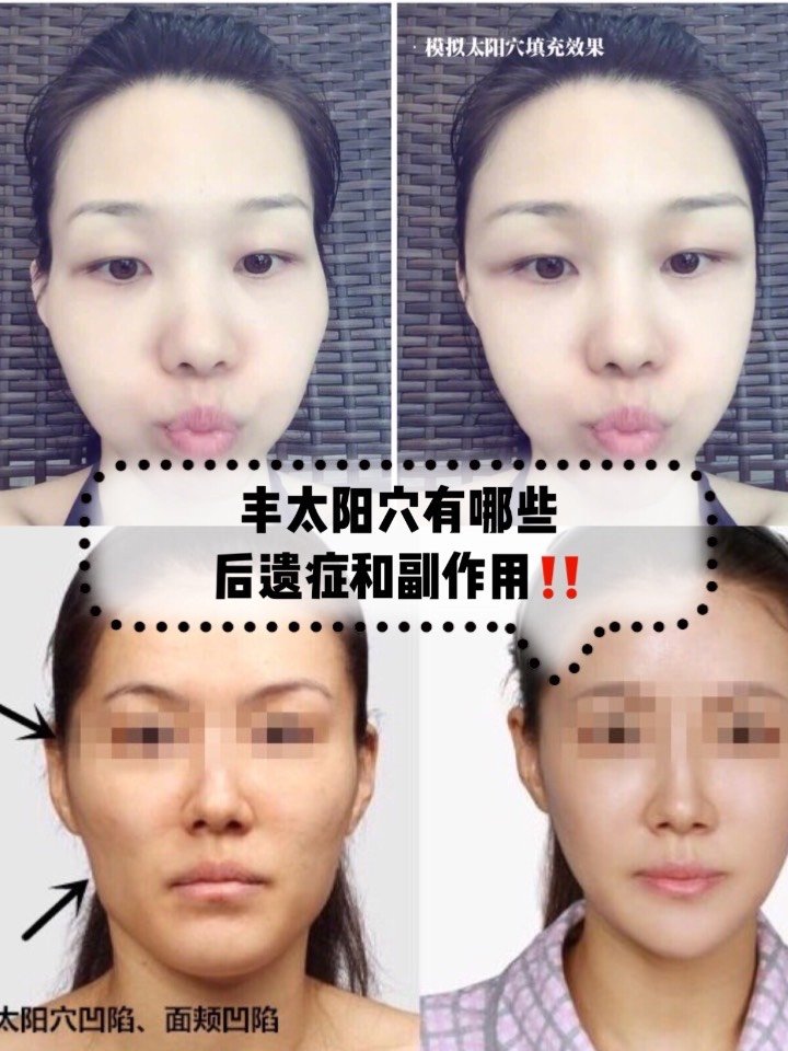 丰太阳穴有什么后遗症?副作用?