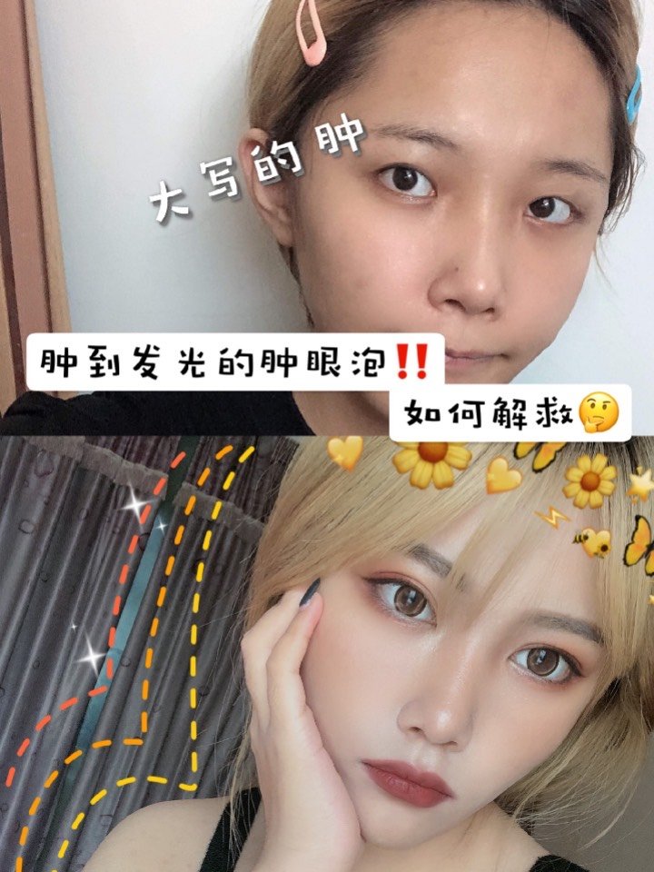 什么是肿眼泡