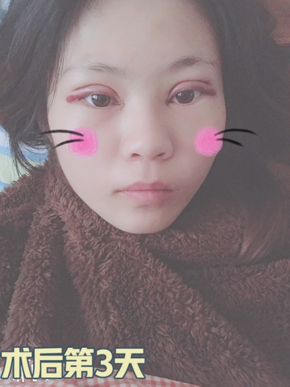 小雪很早就有做双眼皮98的想法了,她的眼睛有些吊眼