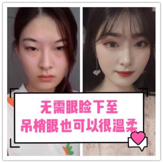 吊梢眼一定要做眼睑下至吗?