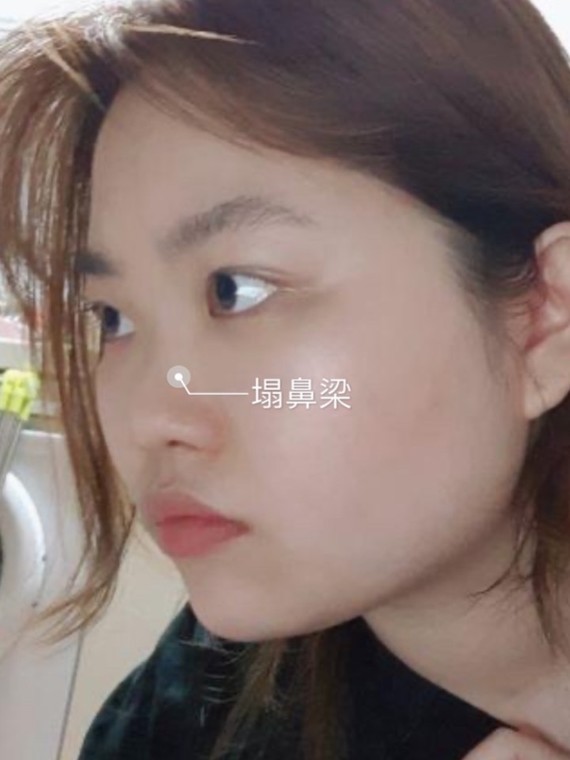 整形的话比较难确定五官改变多少,比如鼻子设计多高以至于瘦下来不