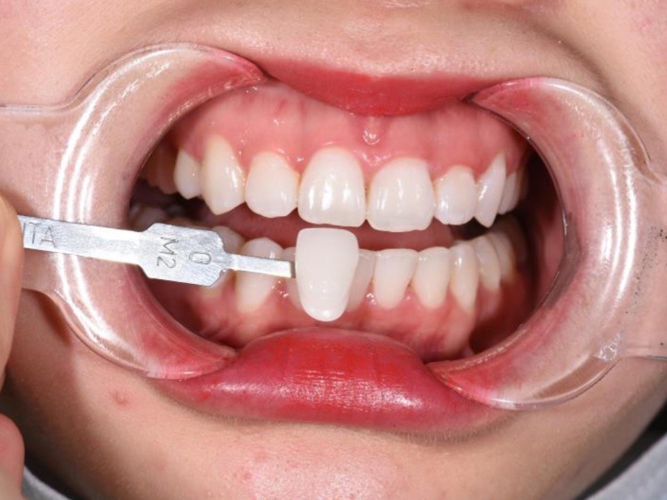 【冷光美白】英国进口专利牙齿美白 好莱坞明星同款 从牙本质透出来的