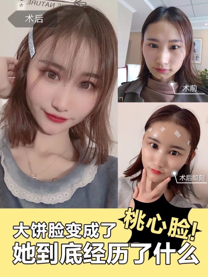 从大饼脸变成了桃心脸,她到底经历了什么?