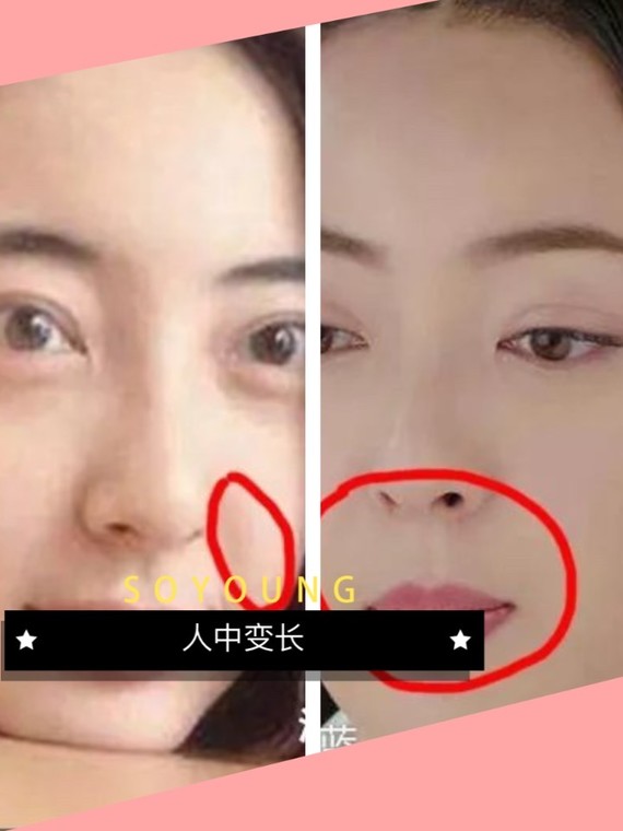 人中变长是我们正常的一个衰老的过程.就拿宣萱来说
