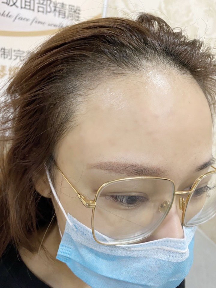 又怕植发太疼 就选择纹发际线 这是纹前的照片 真的太秃了