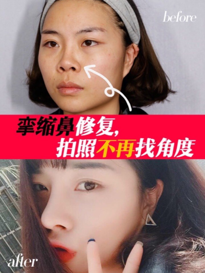 挛缩鼻修复,拍照不再找角度!l型硅胶假体隆鼻术后挛缩案例.