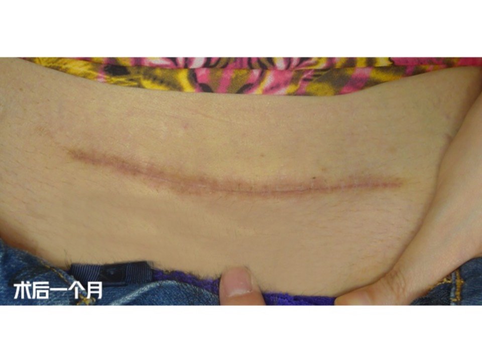 7815【术前分析】横切剖腹产的手术疤痕,疤痕色红