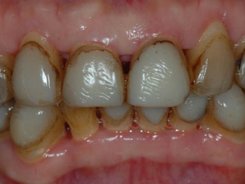做的树脂贴面年头有点久了,下面就是瓷贴面之前的牙齿