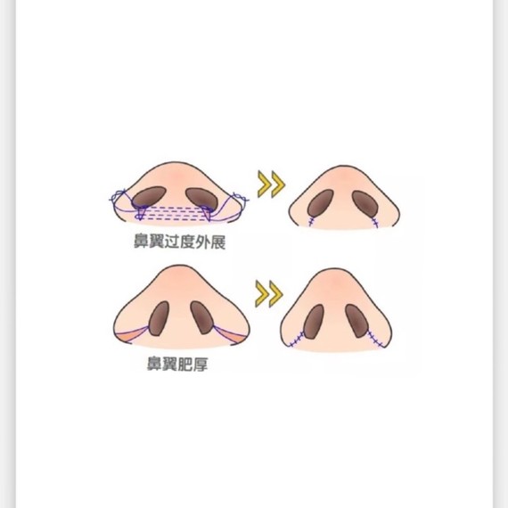 塌鼻梁就注定与美人无缘?