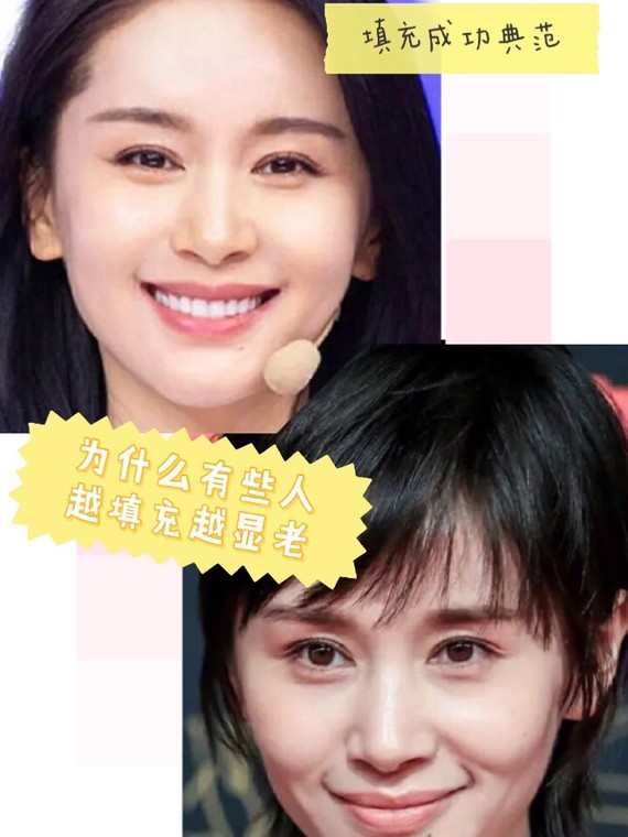 王子文和奚梦瑶都是做面部填充的成功案例,但做面填确