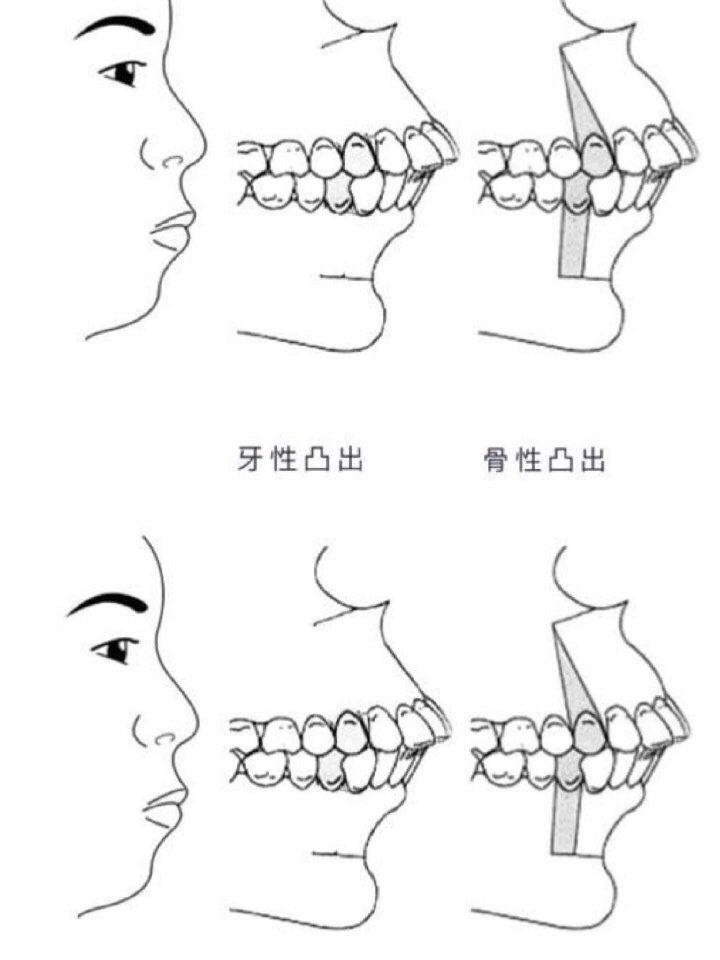 区别骨性凸嘴和齿性凸嘴区别上面的牙向外面中凹陷牙性嘴凸和骨性嘴凸