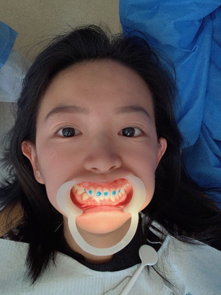 牙齿情况:上牙深覆合,下牙不是很齐