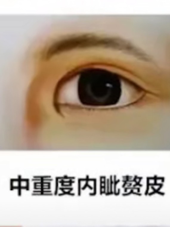 是比较适合去开内眼角的 有的宝宝会不明白内眦赘皮是什么意思