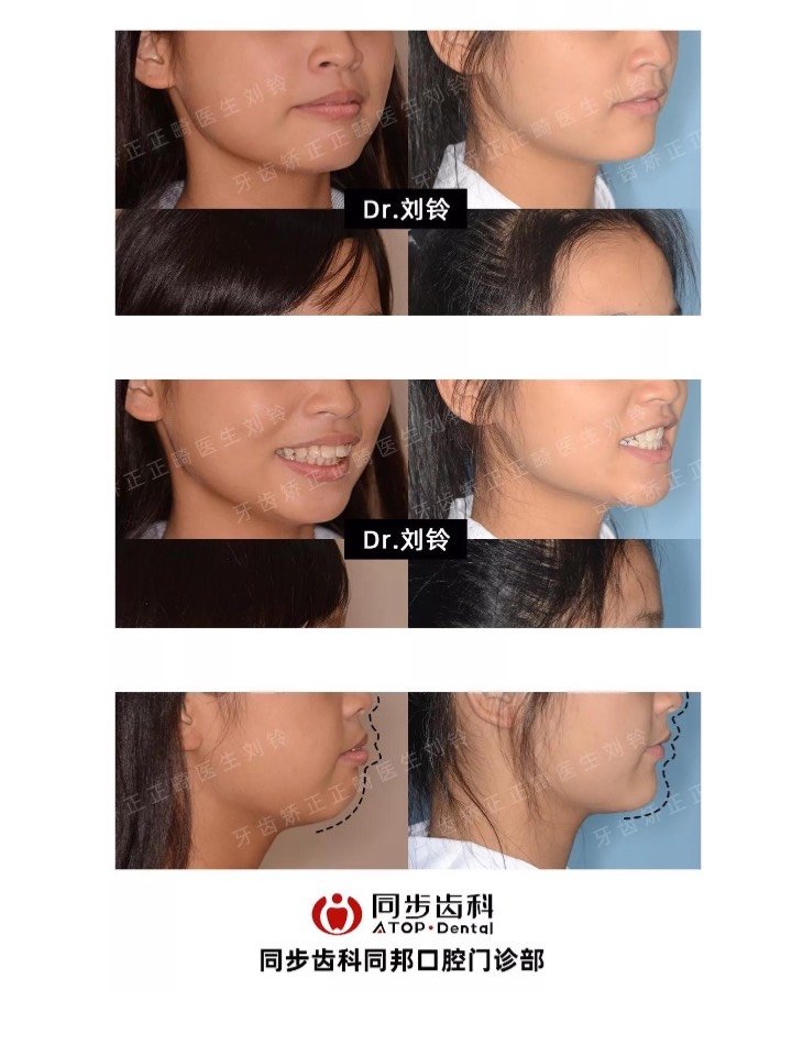 9191看上前牙的外翻度_圈子-新氧美容整形